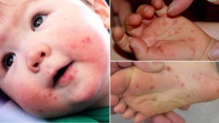 a-doenca-mao-pe-boca-se-apresenta-em-bom-principio